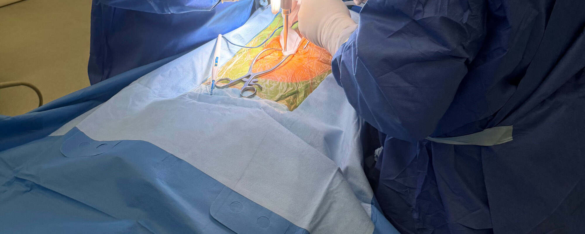 Spinal revision surgery in progress, surgeon’s gloved hands at the operating field