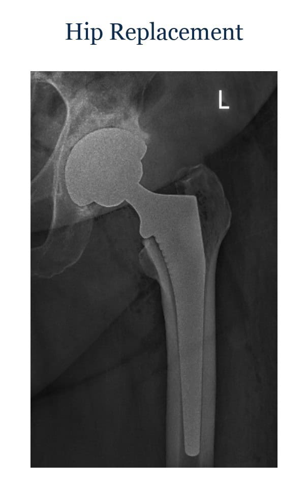Illustration of a hip replacement implant