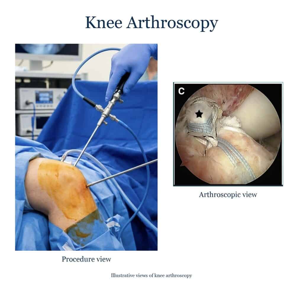 Illustration of knee arthroscopy