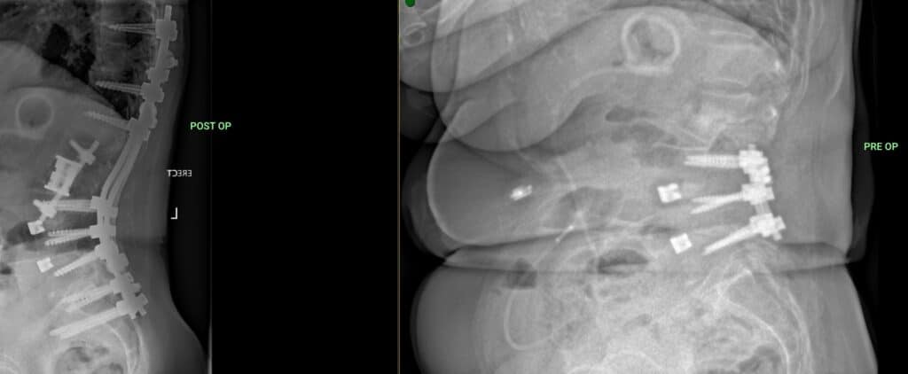 Spine imaging before and after revision surgery
