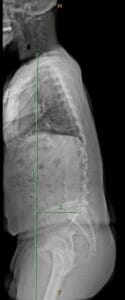 Illustration of sagittal imbalance with forward-stooped posture