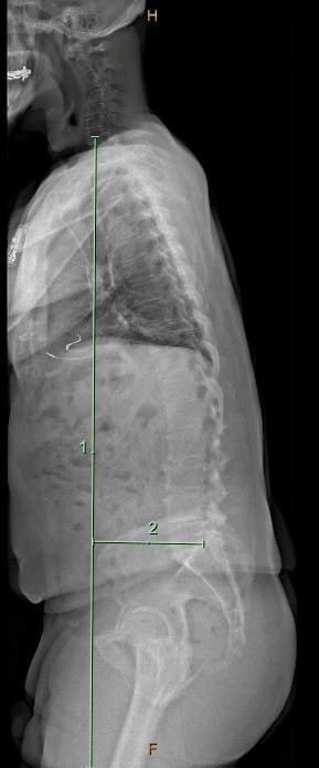 Illustration of sagittal imbalance with forward-stooped posture