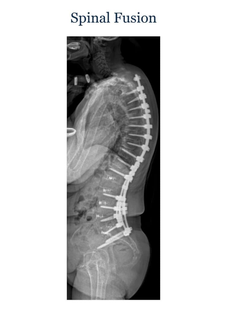 Illustration of spinal fusion with screws and rods